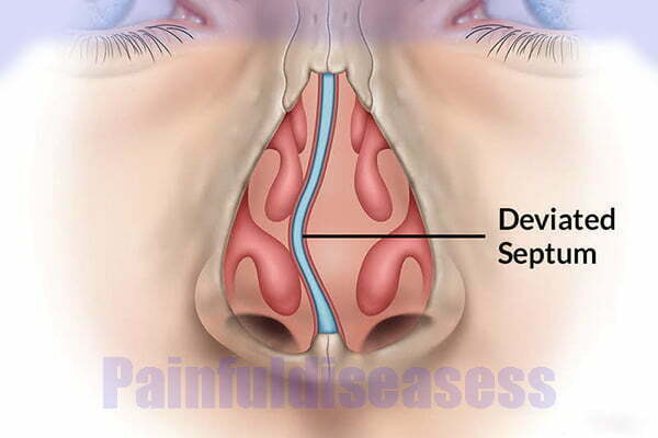 Can a Deviated Septum Cause Headaches