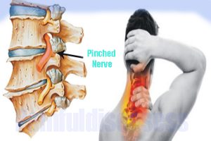 Can A Pinched Nerve Cause Chest Pain? - Painful Diseases