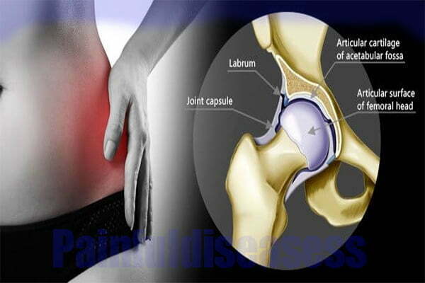 Groin Pain After Hip Replacement