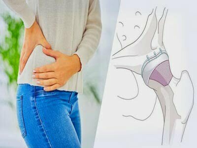 How Do I Prevent Hip Compression Syndrome