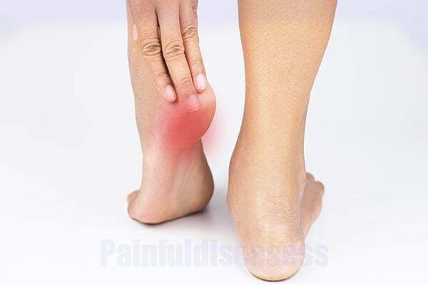 painful-bump-on-bottom-of-heel-symptoms-and-treatment-painful-diseases