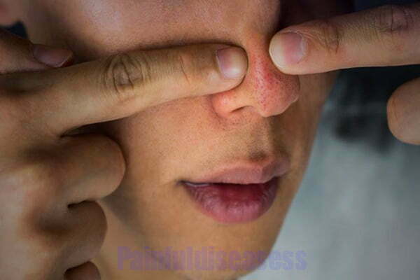 Painful Pimple On Nose