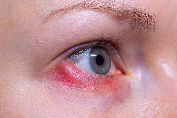 Can A Stye Cause A Headache